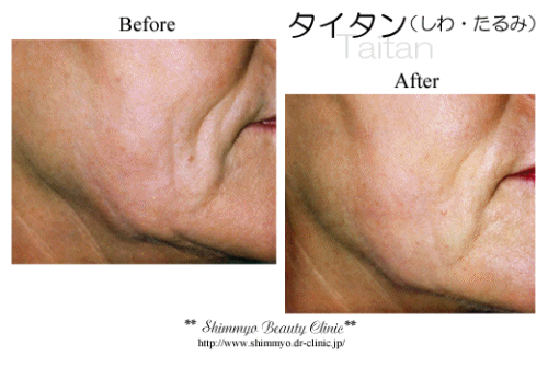 しわ たるみ 小顔 シミ しわ ニキビ 脱毛でお悩みなら奈良県香芝市の新名クリニック